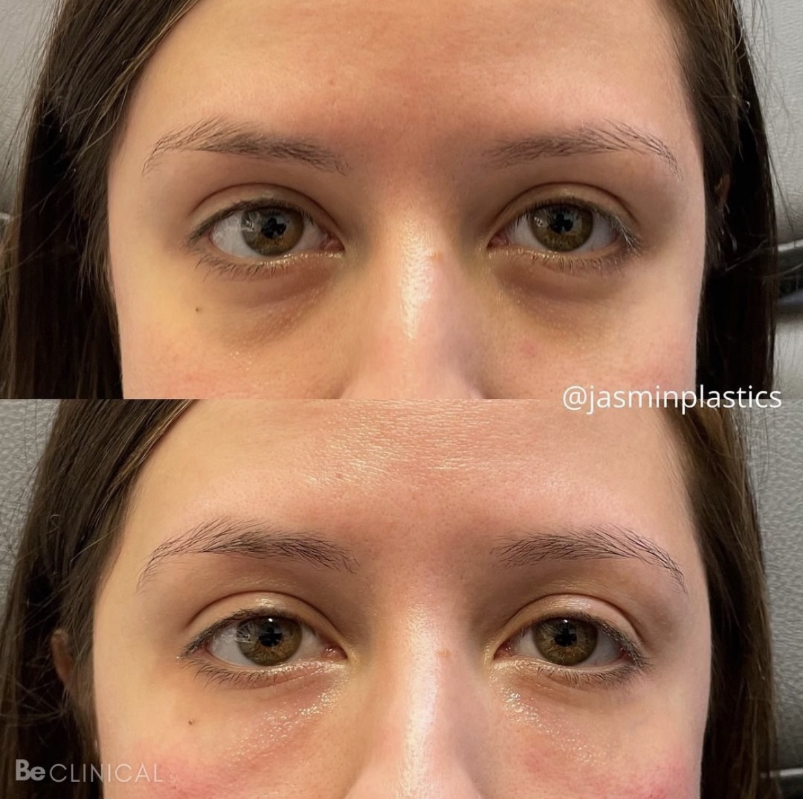juvederm-under-eye-filler-before-after-be-clinical