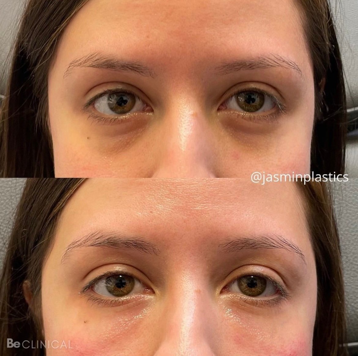 restylane-under-eye-filler-before-after-be-clinical restylane-under-eye-filler-before-after-be-clinical
