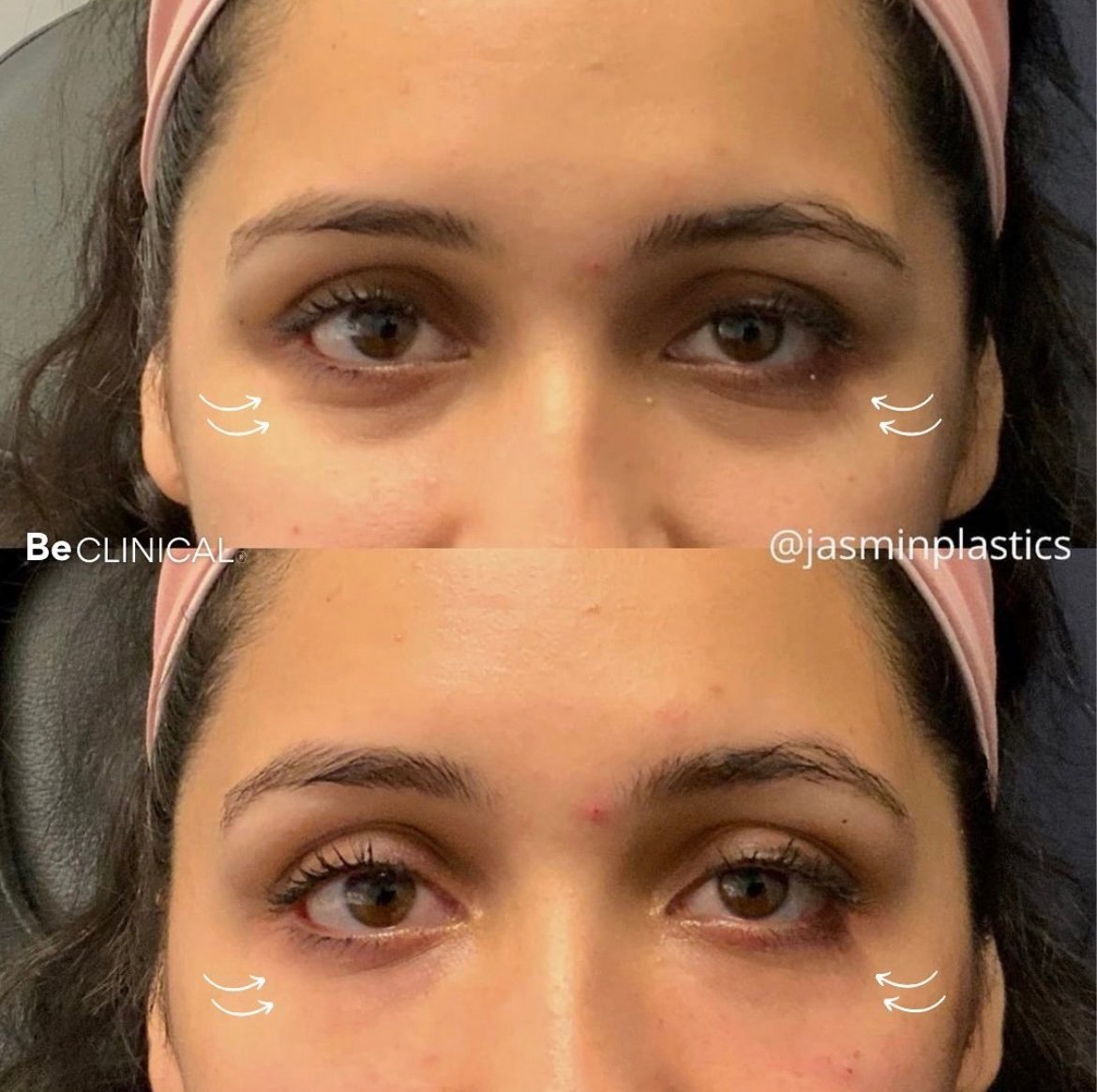 restylane-undereye-filler-before-after-be-clinical